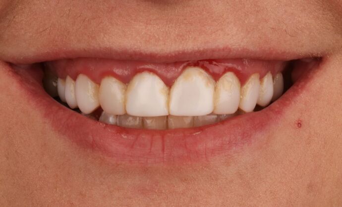 Smile Makeover: Lavonne - Before