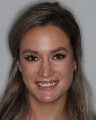 Smile Makeover Lucy - Before