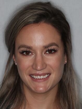 Smile Makeover Lucy - Before