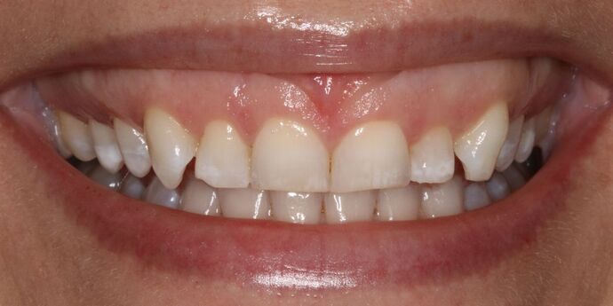 Smile Makeover: Lucy - Before