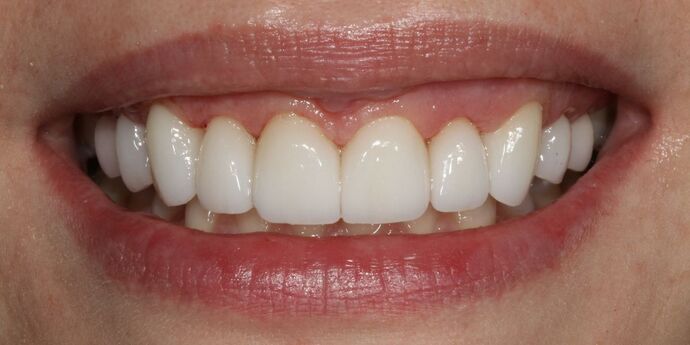 Smile Makeover: Lucy - After