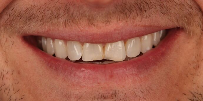 Smile Makeover: Mike - Before