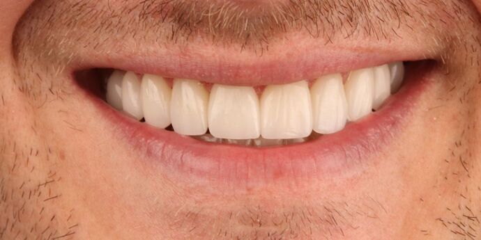 Smile Makeover: Mike - After