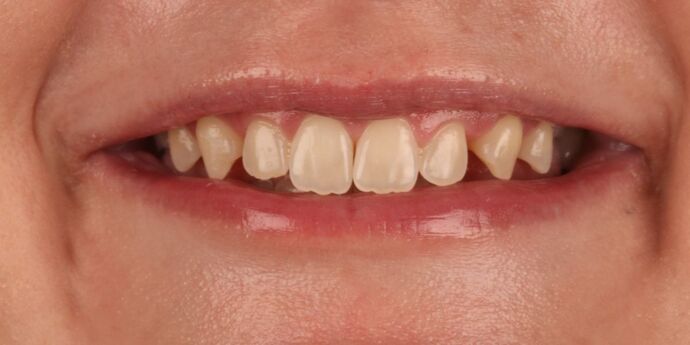 Smile Makeover: Moriah - Before