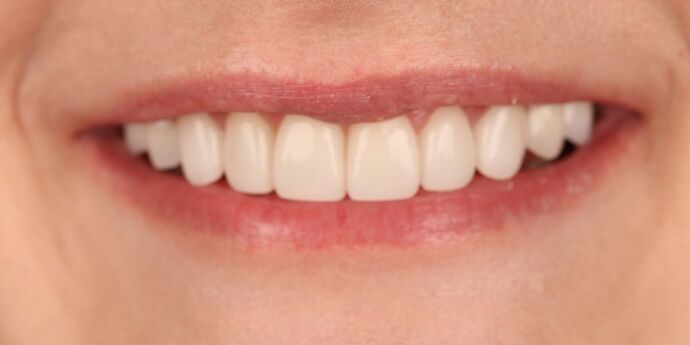 Smile Makeover: Moriah - After