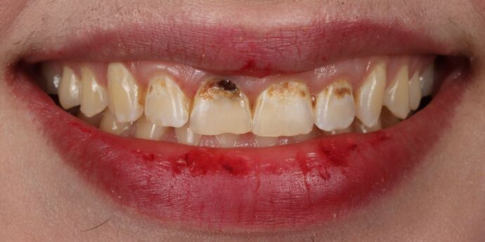 Smile Makeover: Ramona - Before