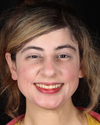 Smile Makeover Ramona - Before