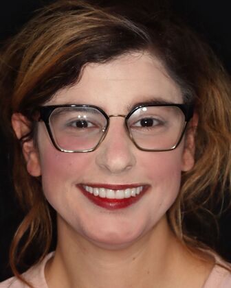 Smile Makeover Ramona - After