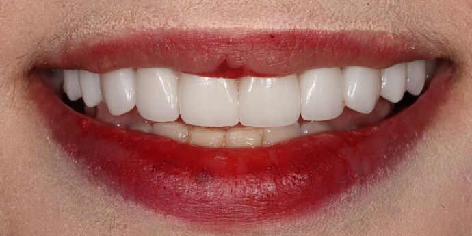 Smile Makeover: Ramona - After