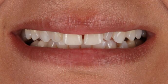 Smile Makeover: Sahar - Before