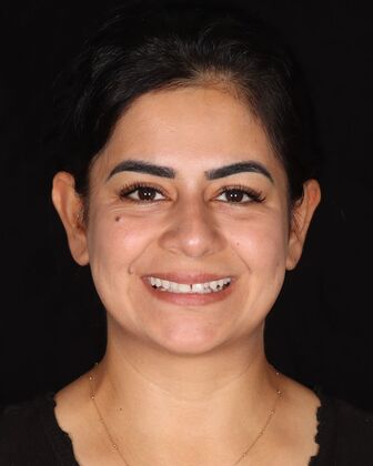 Smile Makeover Sahar - Before