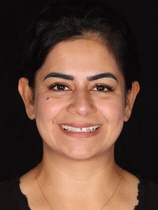 Smile Makeover Sahar - Before