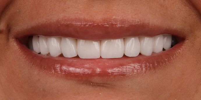 Smile Makeover: Sahar - After