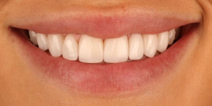 Smile Makeover: Shelby - After