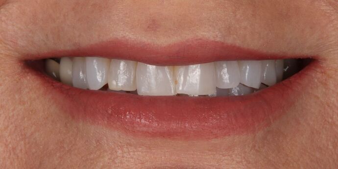 Smile Makeover: Sherri - Before