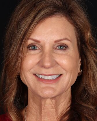 Smile Makeover Sherri - Before