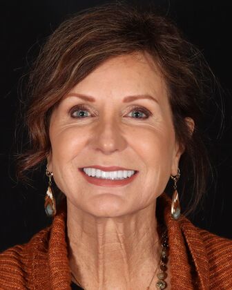 Smile Makeover Sherri - After