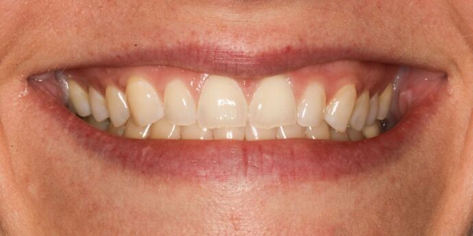 No-Prep Veneers: Andrea - Before