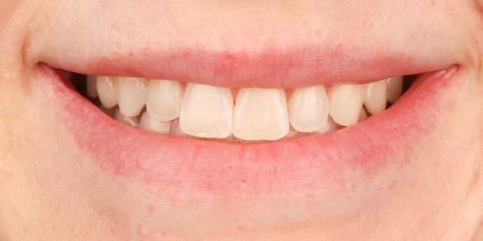 No-Prep Veneers: Ashley - Before