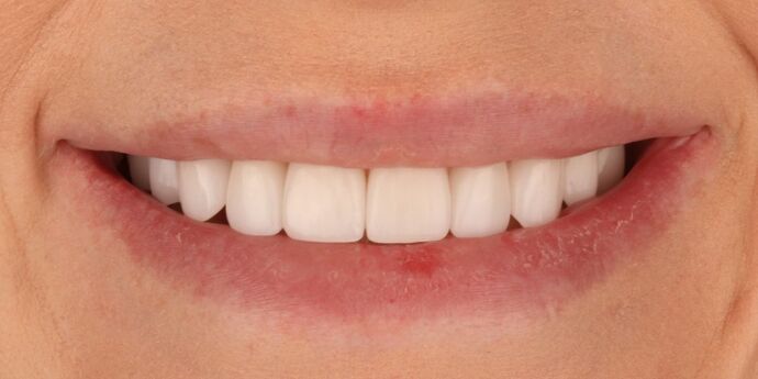 No-Prep Veneers: Ashley - After