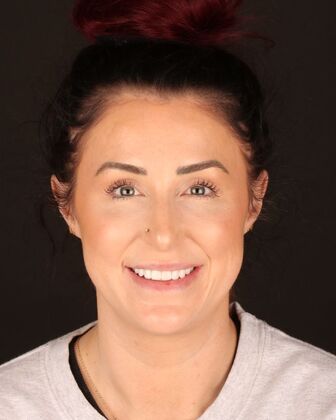 No-Prep Veneers Ashley - After