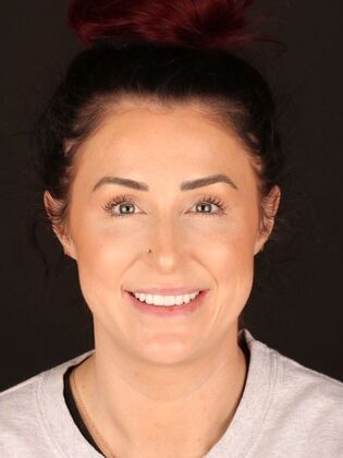 No-Prep Veneers Ashley - After