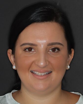 No-Prep Veneers Aylana - Before