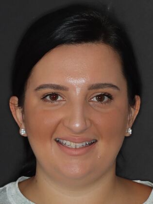 No-Prep Veneers Aylana - Before
