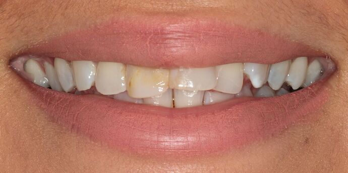 No-Prep Veneers: Aylana - Before