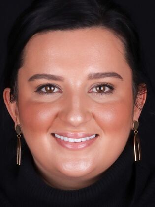 No-Prep Veneers Aylana - After