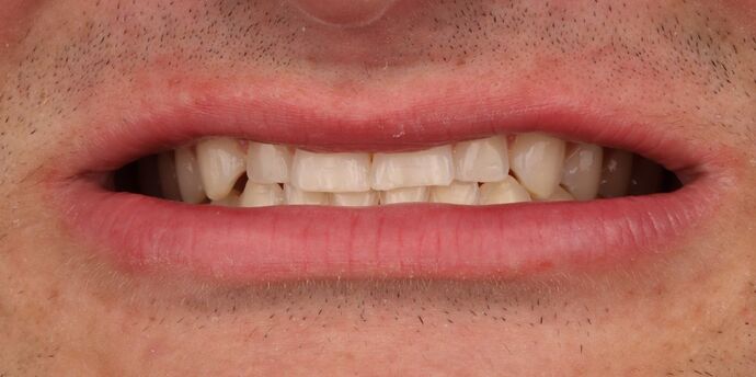No-Prep Veneers: Cal - Before