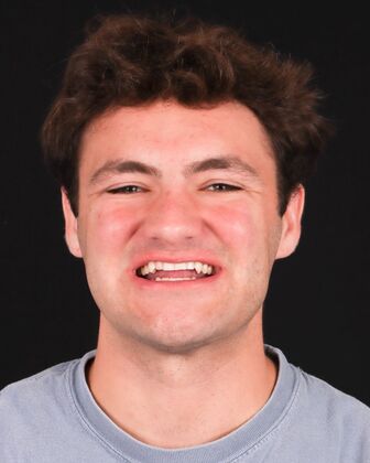 No-Prep Veneers Cal - Before