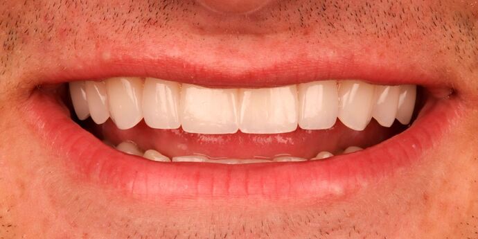 No-Prep Veneers: Cal - After