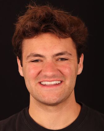 No-Prep Veneers Cal - After