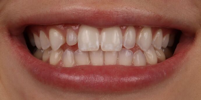 No-Prep Veneers: Gabby - Before