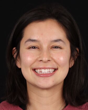 No-Prep Veneers Gabby - Before