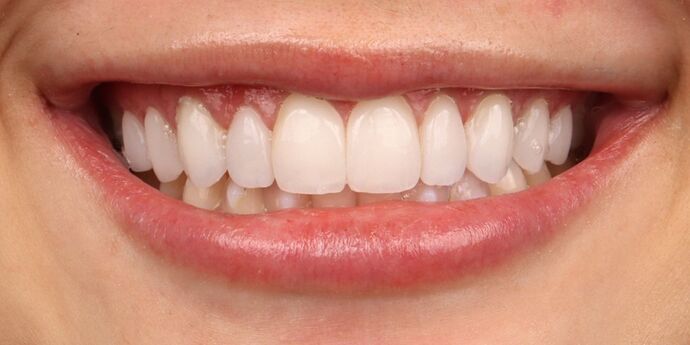 No-Prep Veneers: Gabby - After