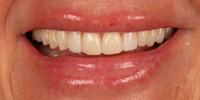 No-Prep Veneers: Jenna - Before