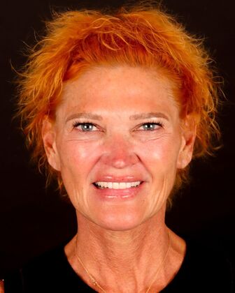 No-Prep Veneers Jenna - Before