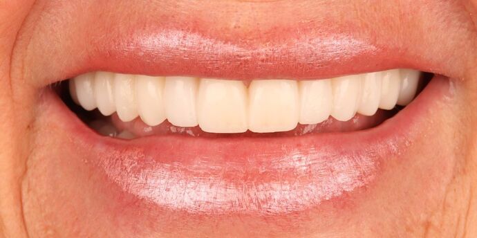 No-Prep Veneers: Jenna - After