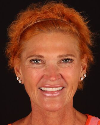 No-Prep Veneers Jenna - After