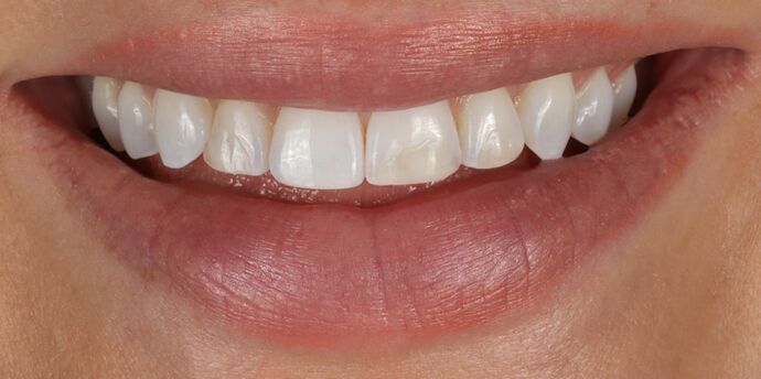 No-Prep Veneers: Kaitlyn - Before