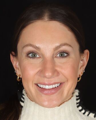 No-Prep Veneers Kaitlyn - Before