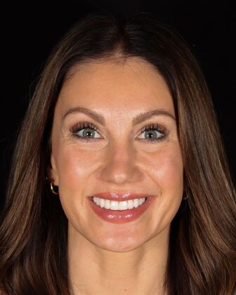 No-Prep Veneers Kaitlyn - After