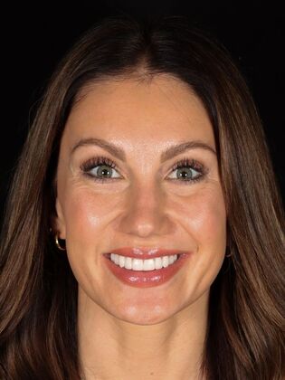 No-Prep Veneers Kaitlyn - After