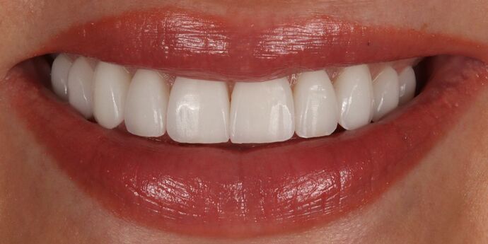 No-Prep Veneers: Kaitlyn - After