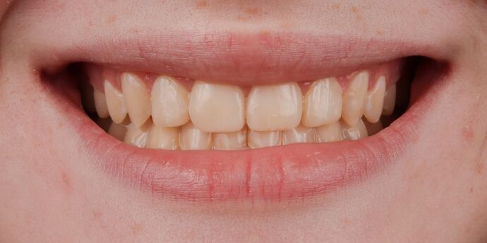 No-Prep Veneers: Lucille - Before