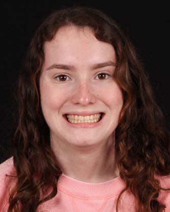 No-Prep Veneers Lucille - Before