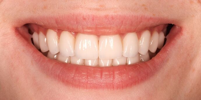 No-Prep Veneers: Lucille - After