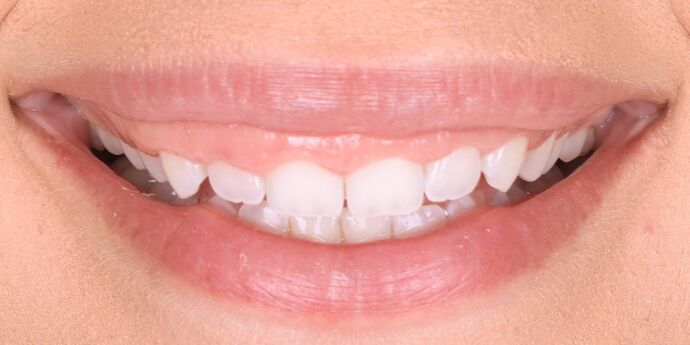 No-Prep Veneers: Patty - Before